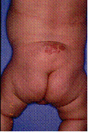 脊髄脂肪腫の画像