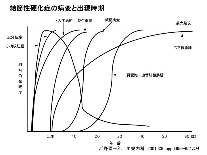 結節性硬化症の病変と出現時期