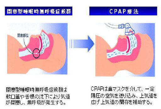 閉塞型無呼吸の治療法