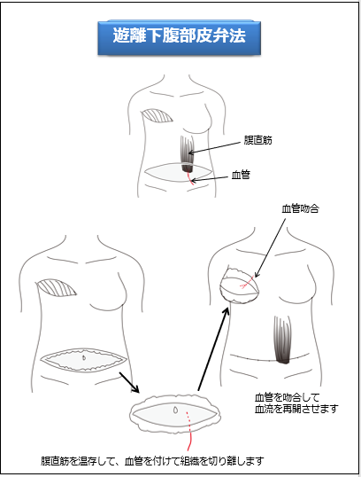 乳腺2