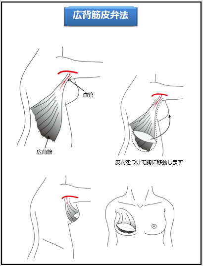 乳腺4