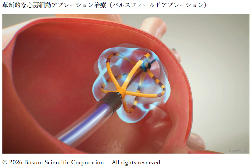 パルスフィールドアブレーションのイメージ画像