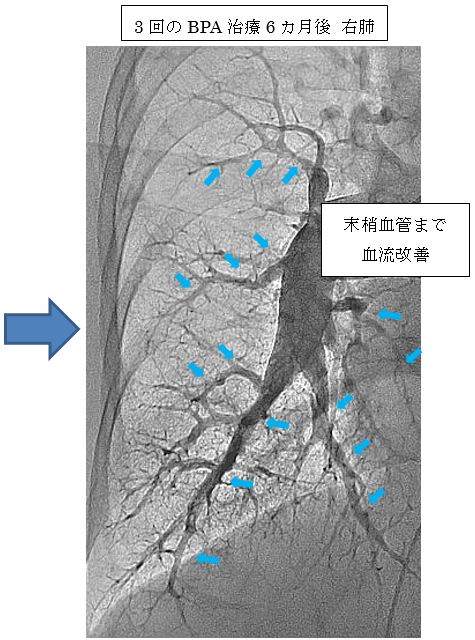 3回目のBPA治療6か月後の右肺の画像写真