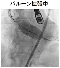 バルーン拡張中