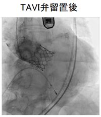 TAVI弁留置後