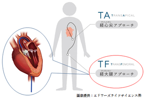 TA（TransApical、経心尖アプローチ）　TF（TransFemoral、経大腿アプローチ）　画像提供：エドワーズライフ