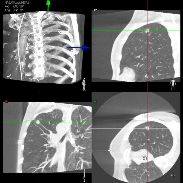 肺がんCT3