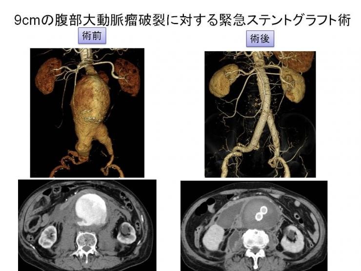 9cmの腹部大動脈瘤破裂に対する緊急ステントグラフト術