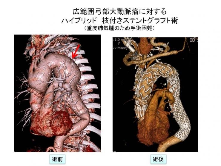 広範囲弓部大動脈瘤に対するハイブリッド枝付きステントグラフト術