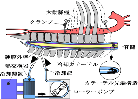 図1局所脊髄冷却システム