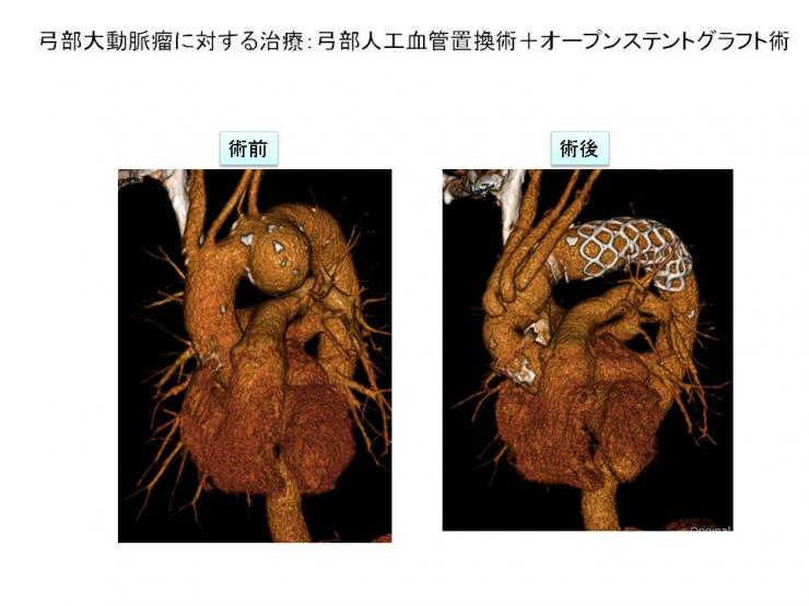 胸部大動脈瘤2