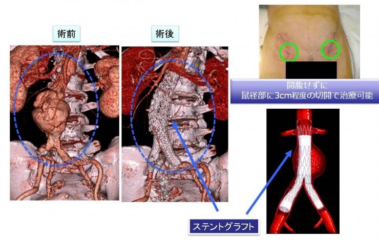 開腹せずに鼠径部に3cm程度の切開で治療可能　術前と術後の写真