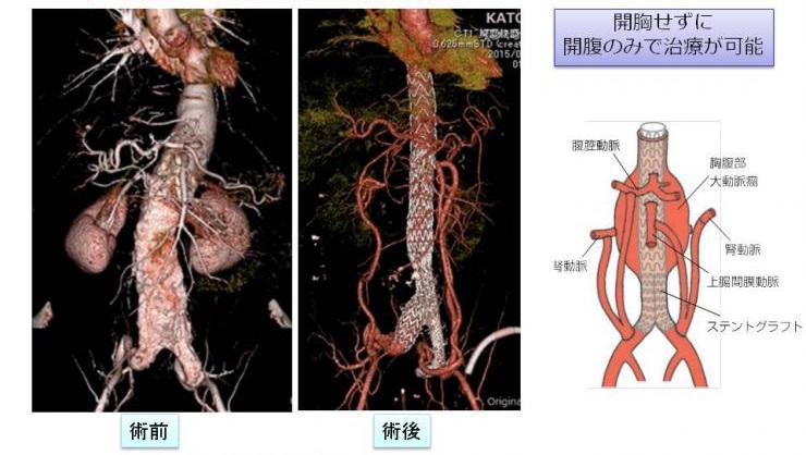 開胸せずに開腹のみで治療が可能　術前と術後の写真