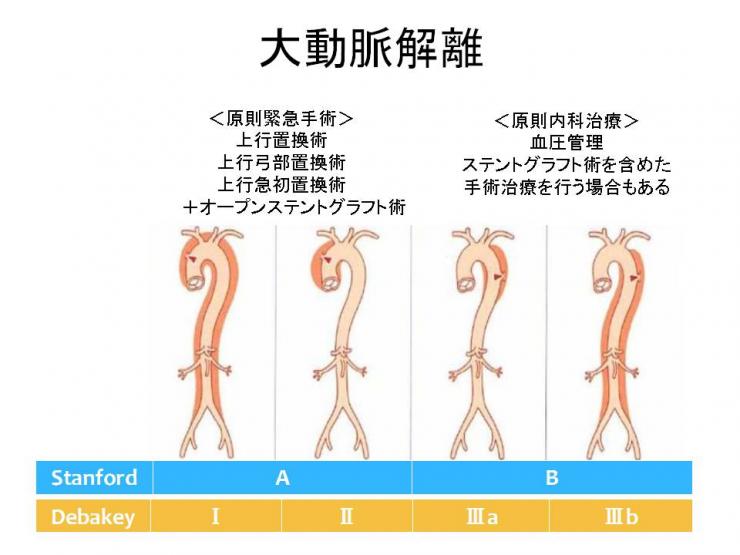 大動脈解離1