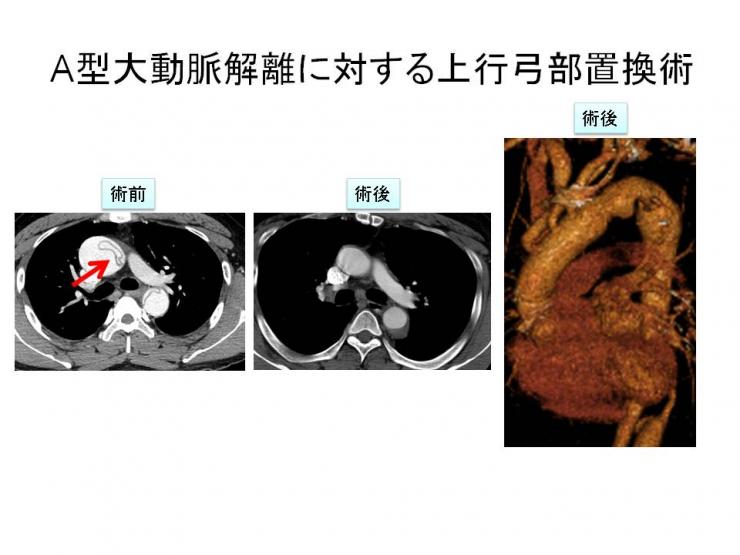 A型大動脈解離1