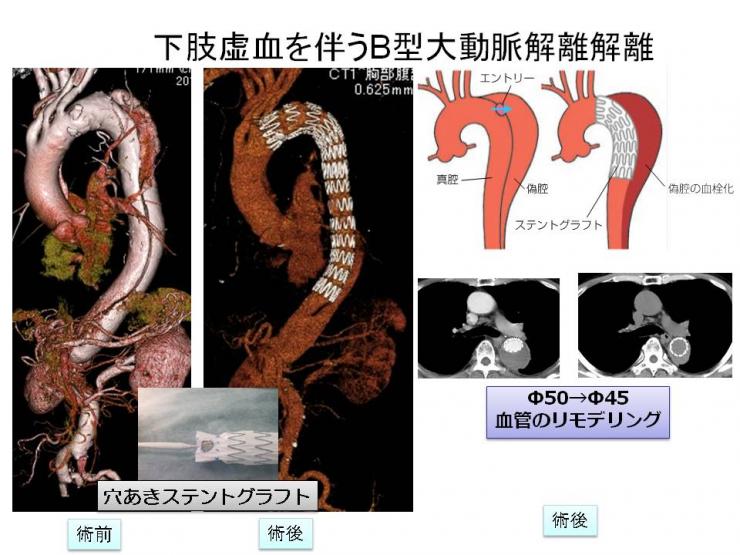 大動脈 解離 退院 後 の 生活