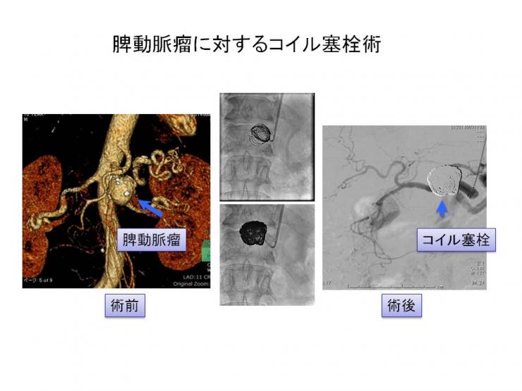 脾動脈瘤に対するコイル塞栓術