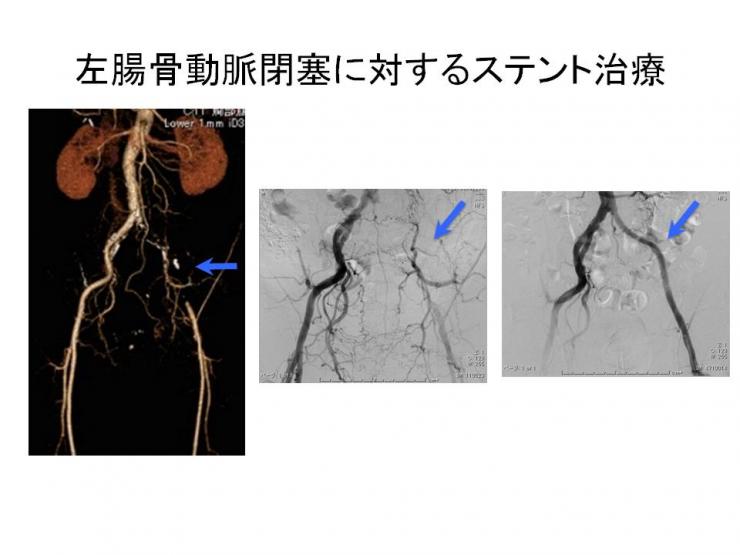 左腸骨動脈閉塞に対するステント治療の画像