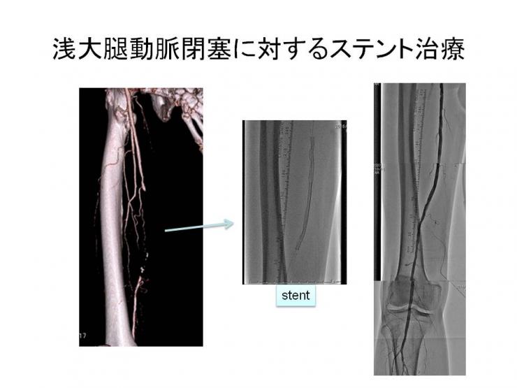 浅大腿動脈閉塞に対するステント治療の画像