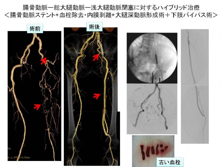 閉塞性動脈硬化症3