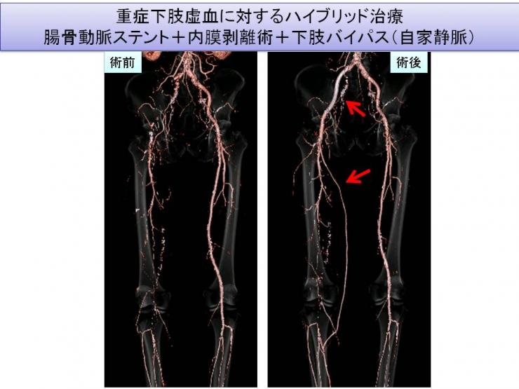 重症下肢虚血に対するハイブリッド治療