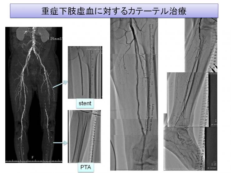 重症下肢虚血に対するカテーテル治療