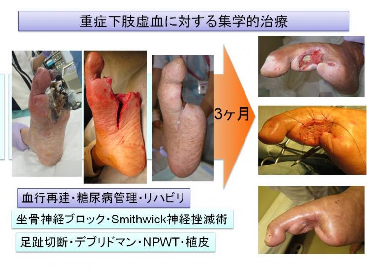 重症下肢虚血に対する集学的治療