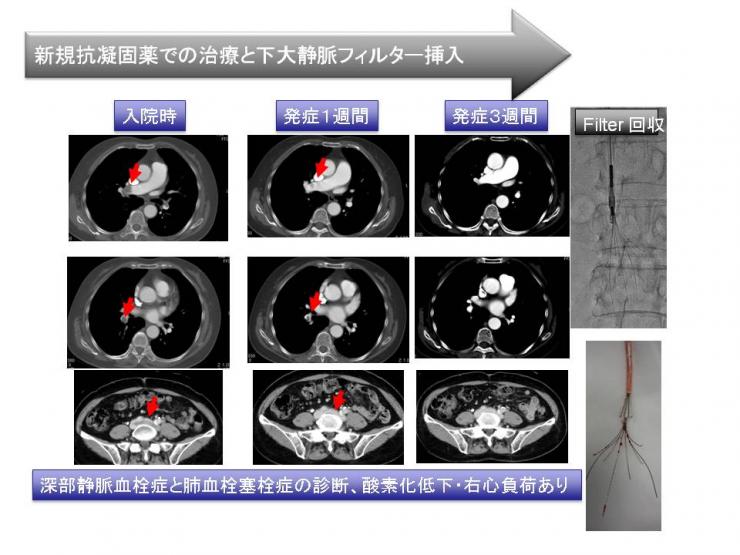 深部静脈血栓症1