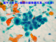 扁平上皮ガン細胞の顕微鏡写真