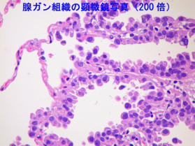 腺ガン組織の顕微鏡写真