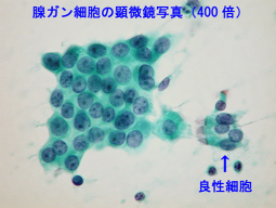 腺ガン細胞の顕微鏡写真