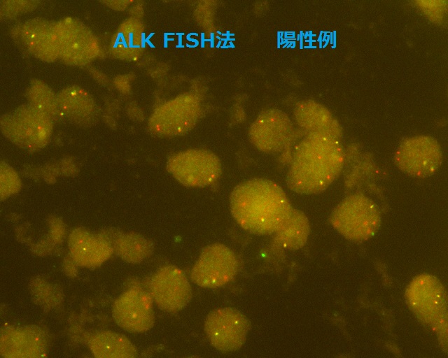 ALK FISH法陽性像