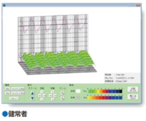 モストグラフ検査（健常者）