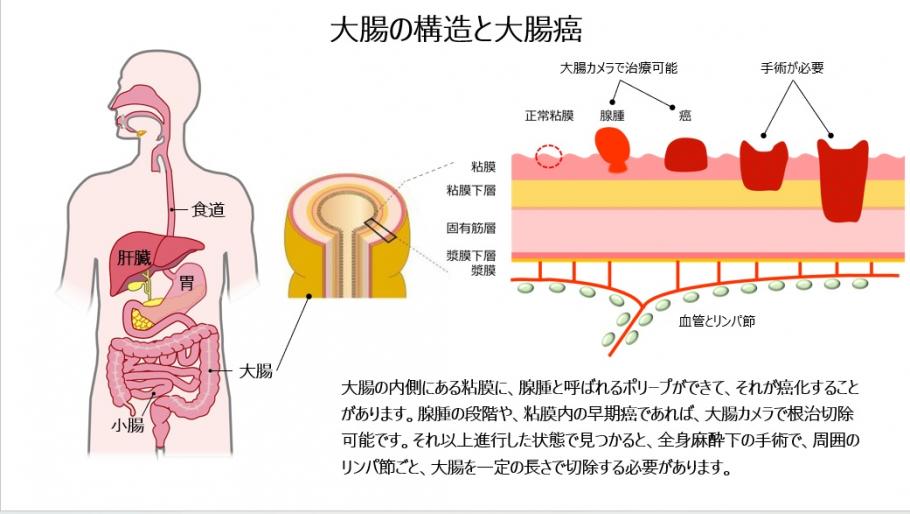 大腸の構造と大腸癌