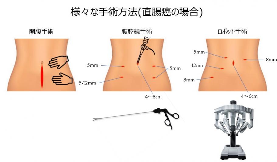 様々な手術方法（直腸癌の場合）