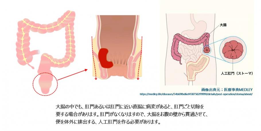直腸癌と人工肛門について