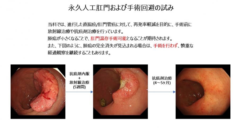 永久人工肛門および手術回避の試み