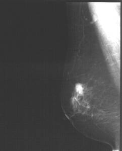乳房X線画像1
