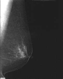 乳房X線画像2