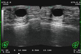 乳腺超音波画像2