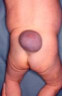 髄膜瘤の画像