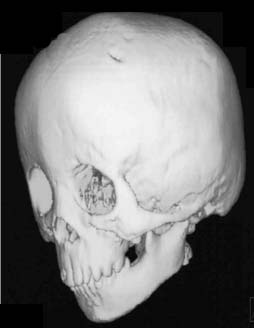頭蓋骨骨延長術術前の画像