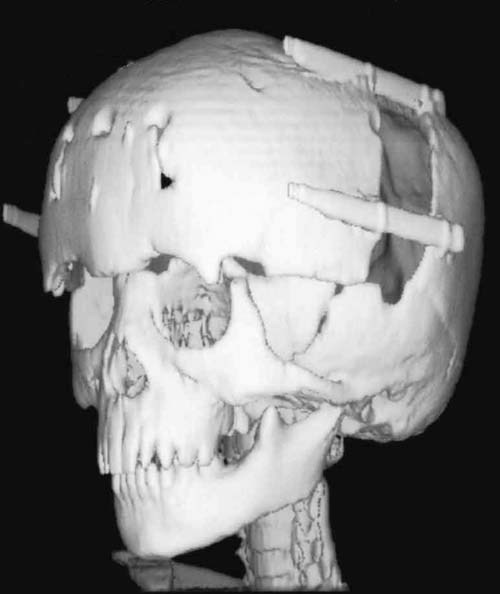 頭蓋骨骨延長術術後の画像