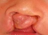 両側完全唇顎口蓋裂術前の写真