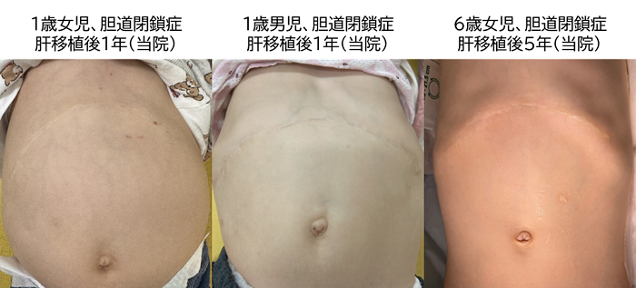 肝移植後の手術創