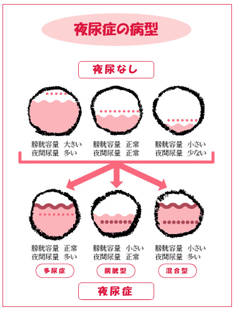 夜尿症の病型