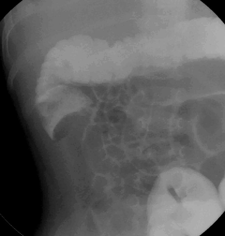 造影検査、腸重積整復術の画像