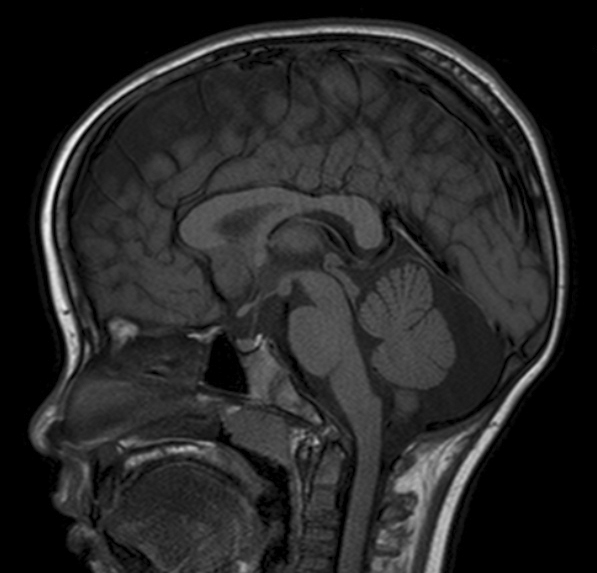 MRI画像、矢状断面